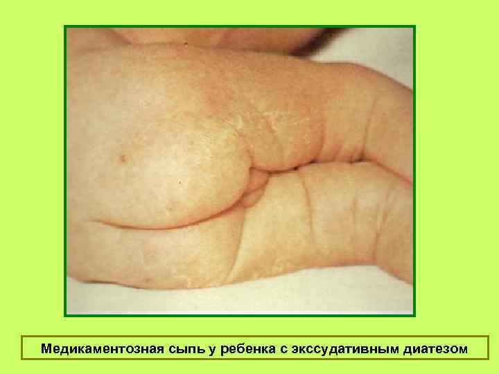 Медикаментозная сыпь у ребенка с экссудативным диатезом 