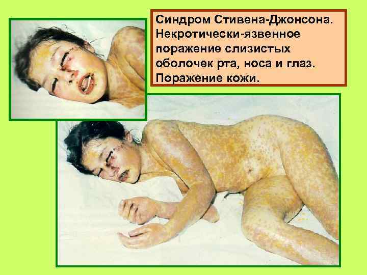 Синдром Стивена-Джонсона. Некротически-язвенное поражение слизистых оболочек рта, носа и глаз. Поражение кожи. 