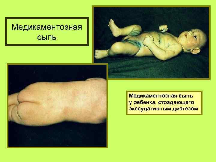 Медикаментозная сыпь у ребенка, страдающего экссудативным диатезом 