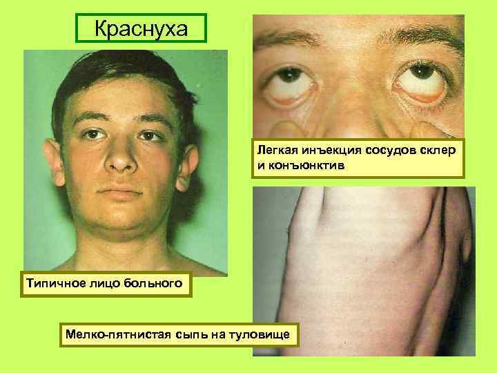 Краснуха Легкая инъекция сосудов склер и конъюнктив Типичное лицо больного Мелко-пятнистая сыпь на туловище
