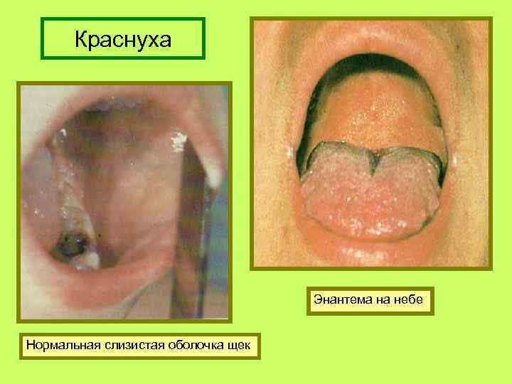 Краснуха Энантема на небе Нормальная слизистая оболочка щек 