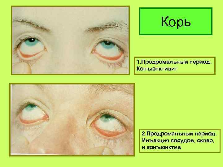 Корь 1. Продромальный период. Конъюнктивит 2. Продромальный период. Инъекция сосудов, склер, и конъюнктив 