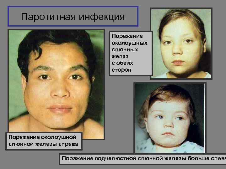 Паротитная инфекция Поражение околоушных слюнных желез с обеих сторон Поражение околоушной слюнной железы справа