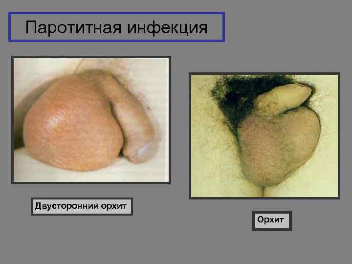 Паротитная инфекция Двусторонний орхит Орхит 