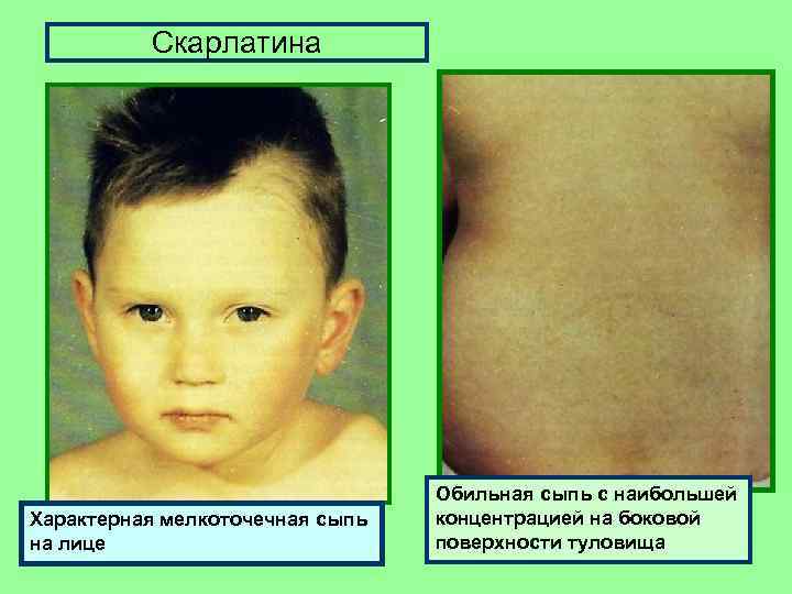 Скарлатина Характерная мелкоточечная сыпь на лице Обильная сыпь с наибольшей концентрацией на боковой поверхности