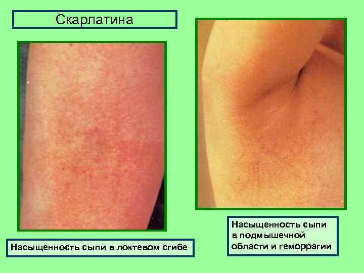 Скарлатина Насыщенность сыпи в локтевом сгибе Насыщенность сыпи в подмышечной области и геморрагии 