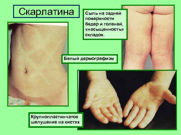 Скарлатина Сыпь на задней поверхности бедер и голеней, «насыщенность» складок. Белый дермографизм Крупнопластинчатое шелушение