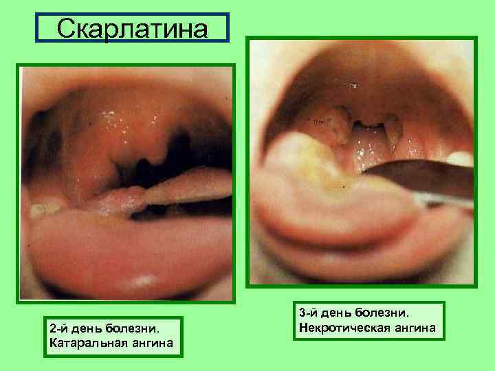 Скарлатина 2 -й день болезни. Катаральная ангина 3 -й день болезни. Некротическая ангина 