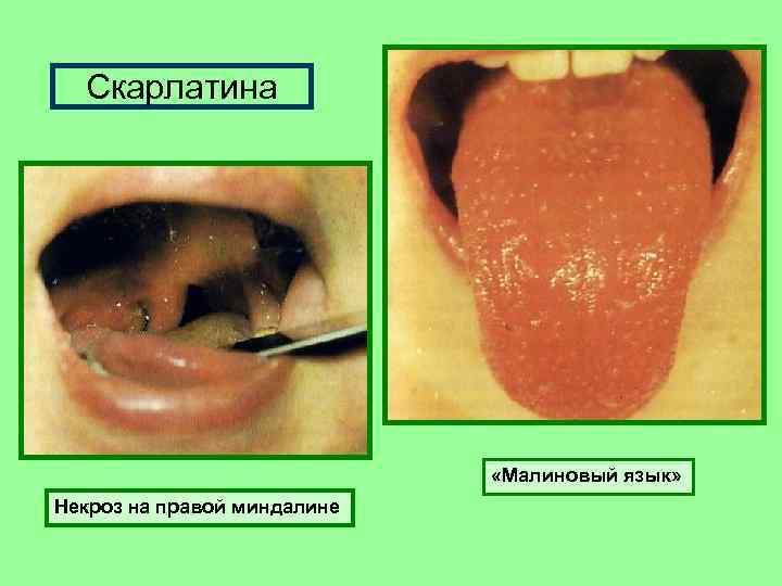 Скарлатина «Малиновый язык» Некроз на правой миндалине 