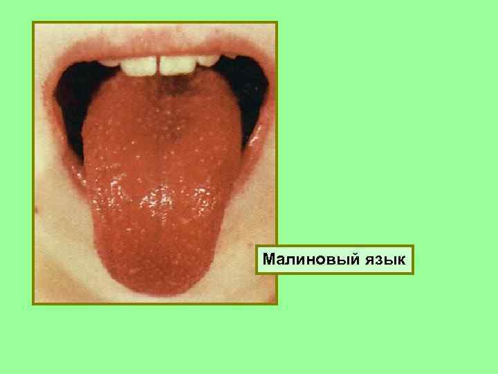 Малиновый язык 