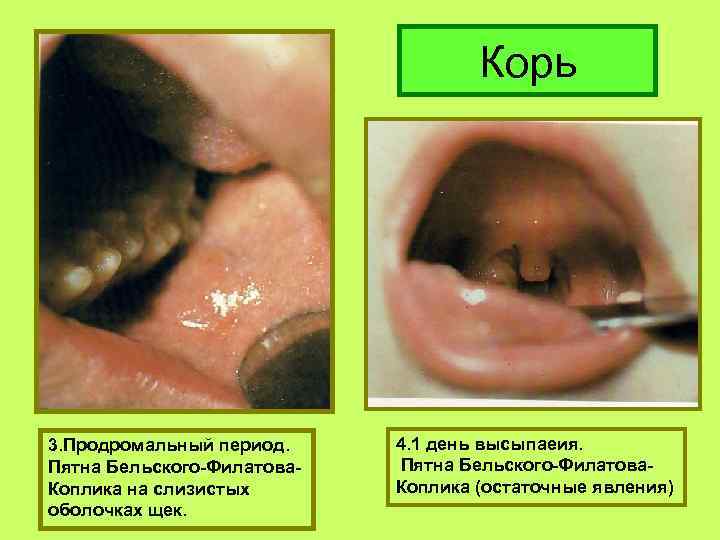 Корь 3. Продромальный период. Пятна Бельского-Филатова. Коплика на слизистых оболочках щек. 4. 1 день