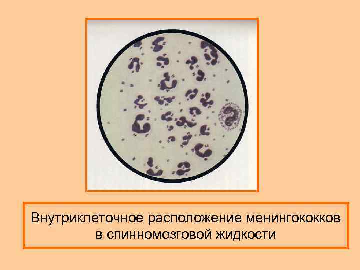 Внутриклеточное расположение менингококков в спинномозговой жидкости 