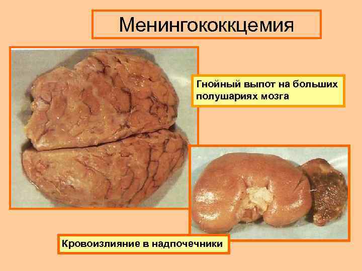 Менингококкцемия Гнойный выпот на больших полушариях мозга Кровоизлияние в надпочечники 