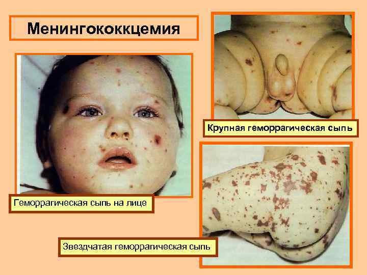 Менингококкцемия Крупная геморрагическая сыпь Геморрагическая сыпь на лице Звездчатая геморрагическая сыпь 