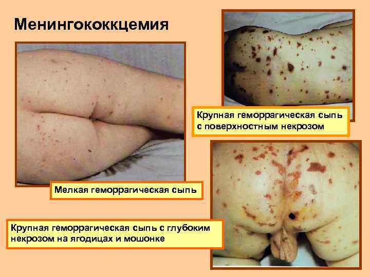 Менингококкцемия Крупная геморрагическая сыпь с поверхностным некрозом Мелкая геморрагическая сыпь Крупная геморрагическая сыпь с