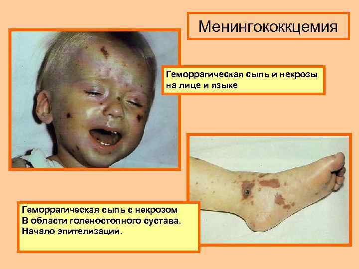 Менингококкцемия Геморрагическая сыпь и некрозы на лице и языке Геморрагическая сыпь с некрозом В