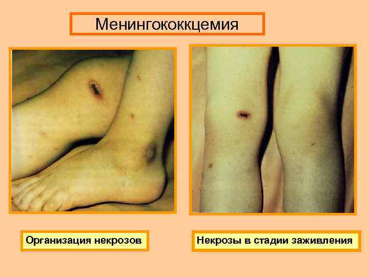 Менингококкцемия Организация некрозов Некрозы в стадии заживления 