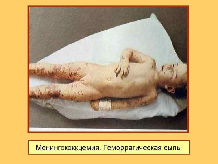 Менингококкцемия. Геморрагическая сыпь. 