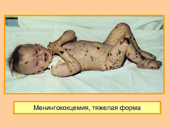 Менингококцемия, тяжелая форма 