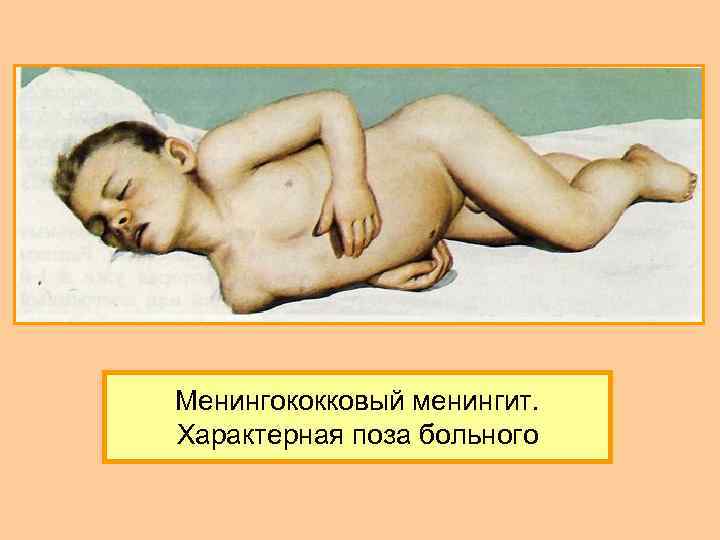 Менингококковый менингит. Характерная поза больного 