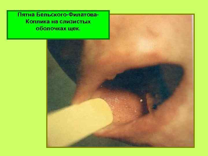 Пятна Бельского-Филатова. Коплика на слизистых оболочках щек. 