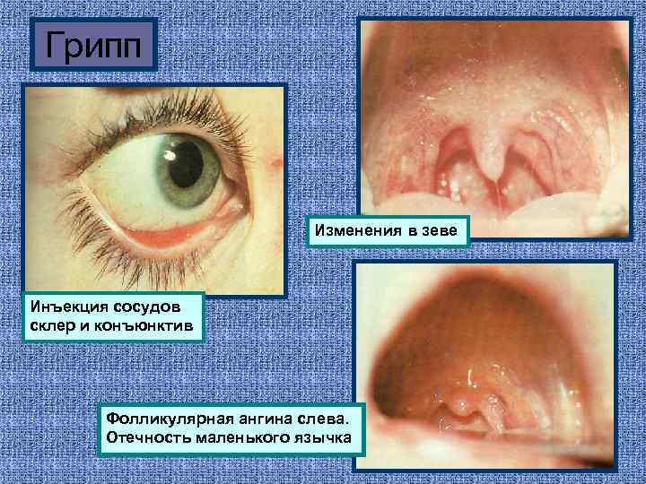 Грипп Изменения в зеве Инъекция сосудов склер и конъюнктив Фолликулярная ангина слева. Отечность маленького