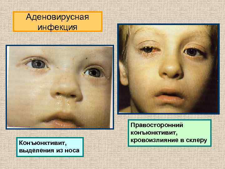 Аденовирусная инфекция Конъюнктивит, выделения из носа Правосторонний конъюнктивит, кровоизлияние в склеру 