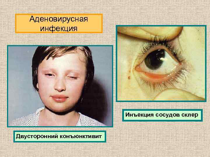Аденовирусная инфекция Инъекция сосудов склер Двусторонний конъюнктивит 