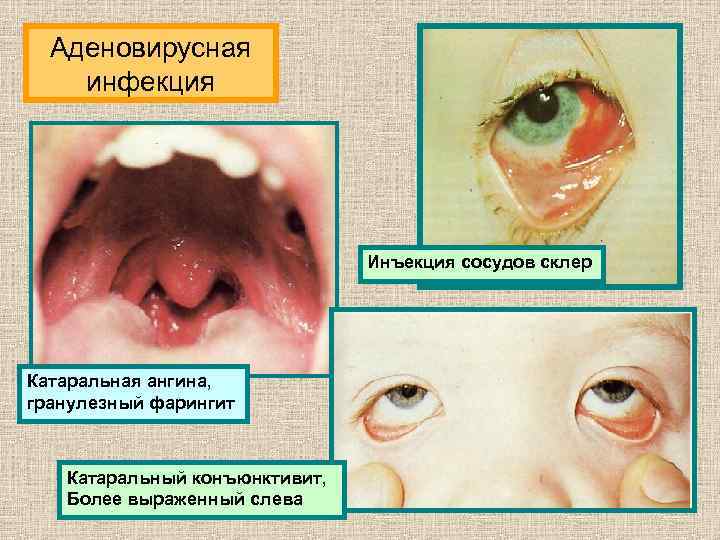 Аденовирусная инфекция Инъекция сосудов склер Катаральная ангина, гранулезный фарингит Катаральный конъюнктивит, Более выраженный слева