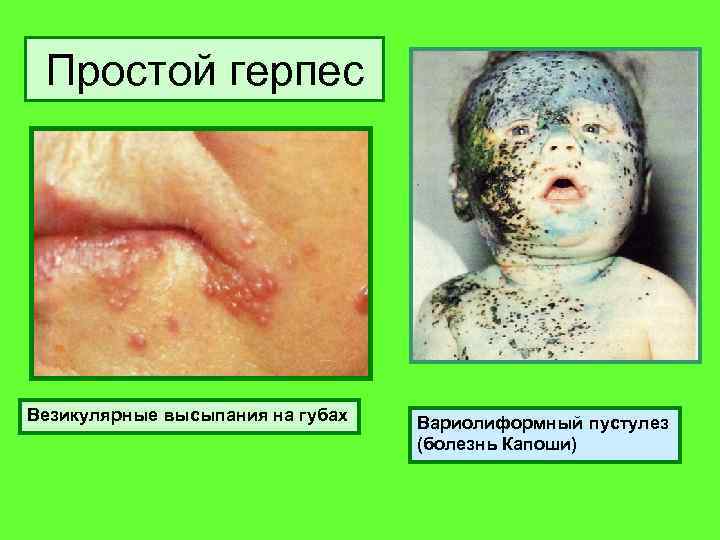 Простой герпес Везикулярные высыпания на губах Вариолиформный пустулез (болезнь Капоши) 