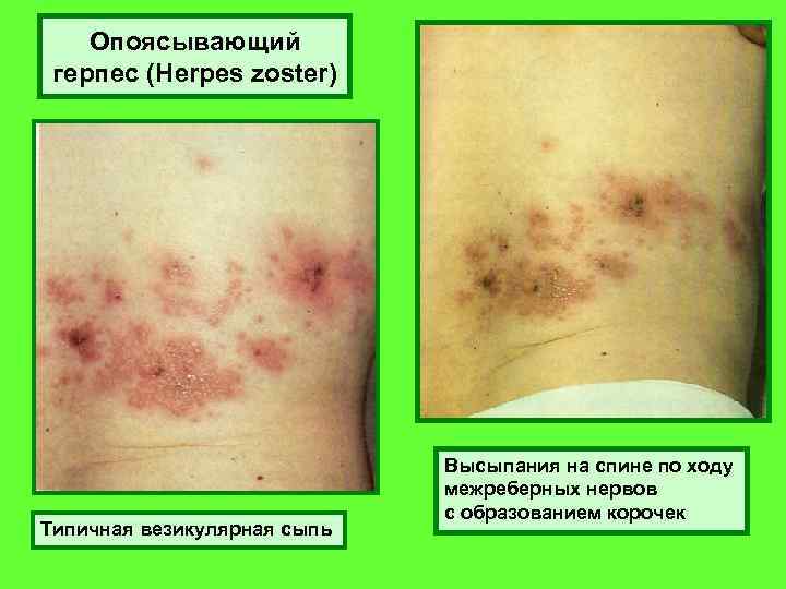 Опоясывающий герпес (Herpes zoster) Типичная везикулярная сыпь Высыпания на спине по ходу межреберных нервов