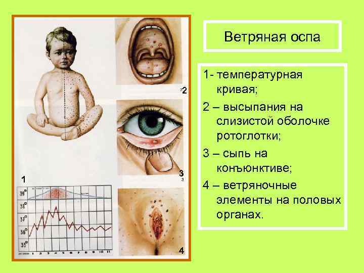 Ветряная оспа 2 1 3 4 1 - температурная кривая; 2 – высыпания на