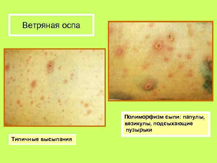 Ветряная оспа Полиморфизм сыпи: папулы, везикулы, подсыхающие пузырьки Типичные высыпания 