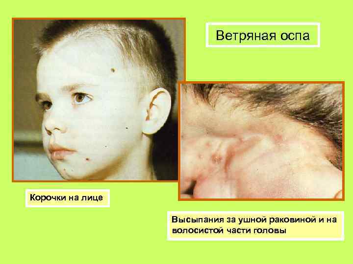 Ветряная оспа Корочки на лице Высыпания за ушной раковиной и на волосистой части головы