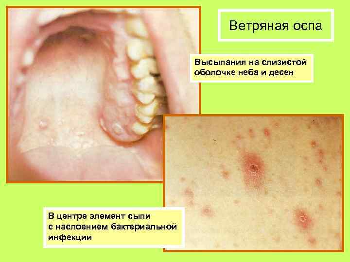 Ветряная оспа Высыпания на слизистой оболочке неба и десен В центре элемент сыпи с