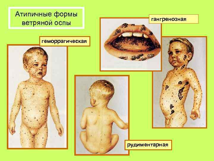 Атипичные формы ветряной оспы гангренозная геморрагическая рудиментарная 