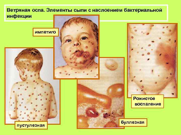 Ветряная оспа. Элементы сыпи с наслоением бактериальной инфекции импетиго Рожистое воспаление пустулезная буллезная 