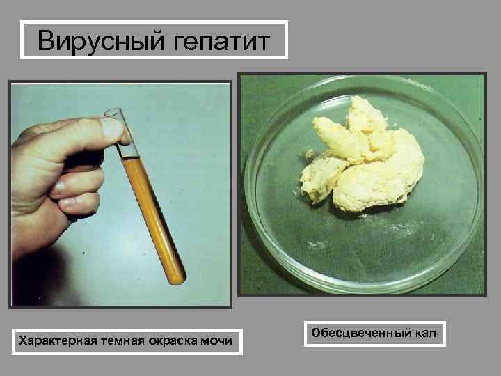 Вирусный гепатит Характерная темная окраска мочи Обесцвеченный кал 