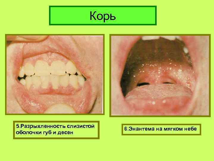 Корь 5. Разрыхленность слизистой оболочки губ и десен 6. Энантема на мягком небе 
