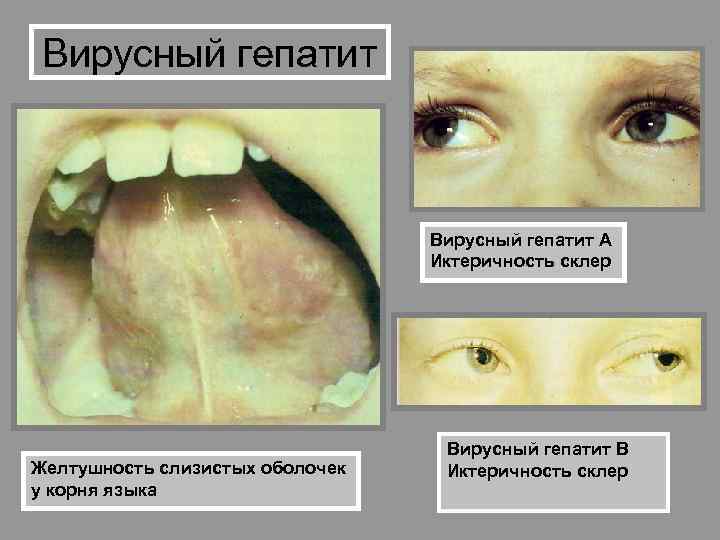 Вирусный гепатит А Иктеричность склер Желтушность слизистых оболочек у корня языка Вирусный гепатит В