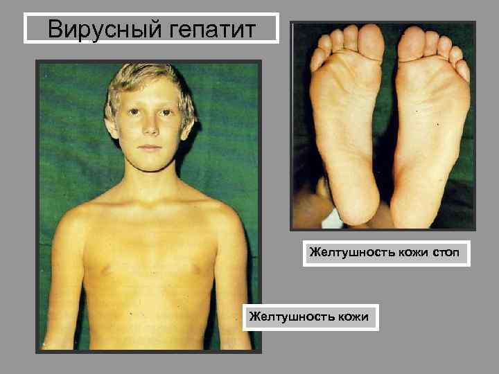 Вирусный гепатит Желтушность кожи стоп Желтушность кожи 
