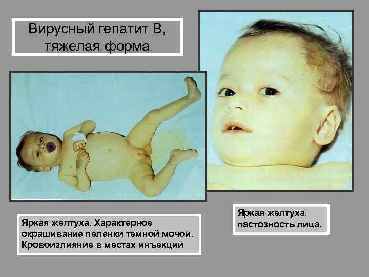 Вирусный гепатит В, тяжелая форма Яркая желтуха. Характерное окрашивание пеленки темной мочой. Кровоизлияние в