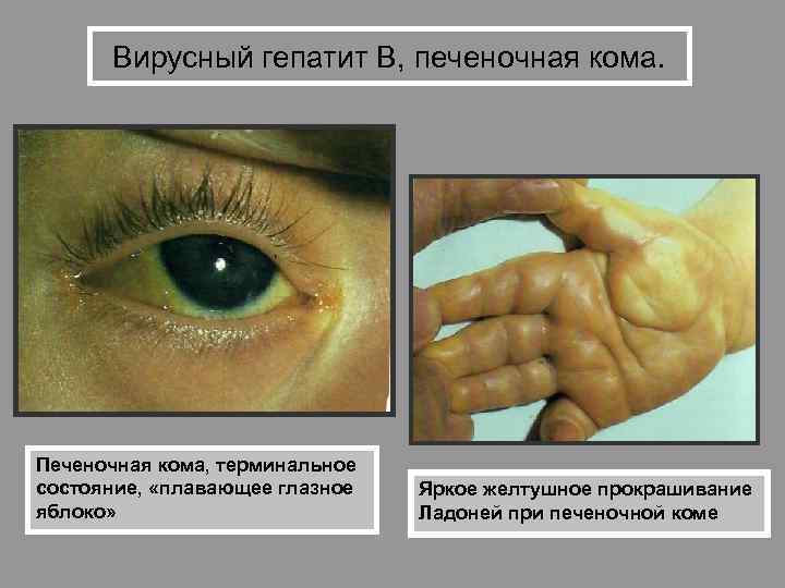 Вирусный гепатит В, печеночная кома. Печеночная кома, терминальное состояние, «плавающее глазное яблоко» Яркое желтушное