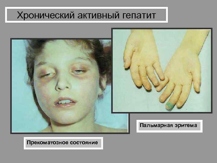 Хронический активный гепатит Пальмарная эритема Прекоматозное состояние 