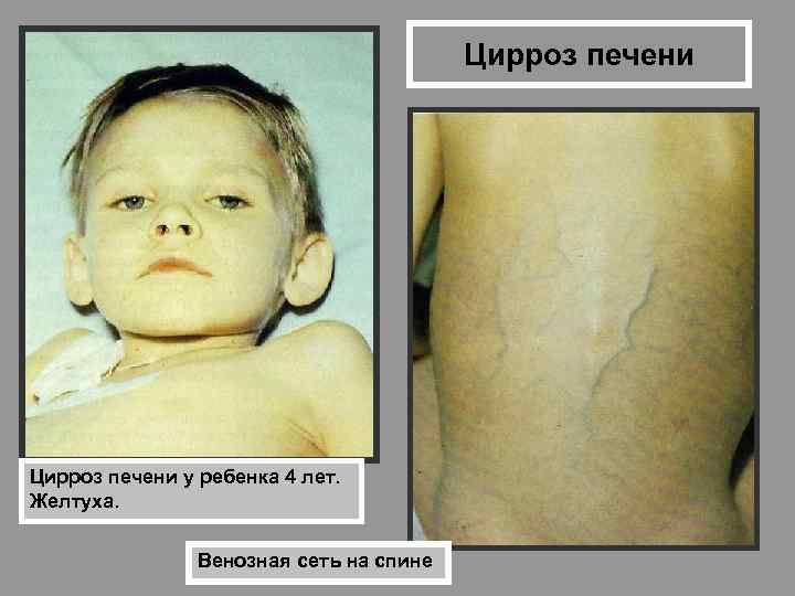 Цирроз печени у ребенка 4 лет. Желтуха. Венозная сеть на спине 