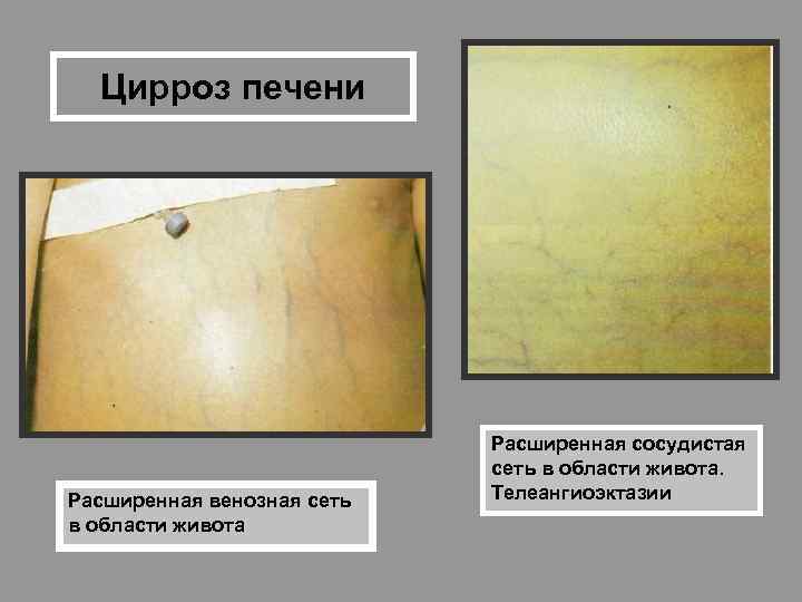 Цирроз печени Расширенная венозная сеть в области живота Расширенная сосудистая сеть в области живота.