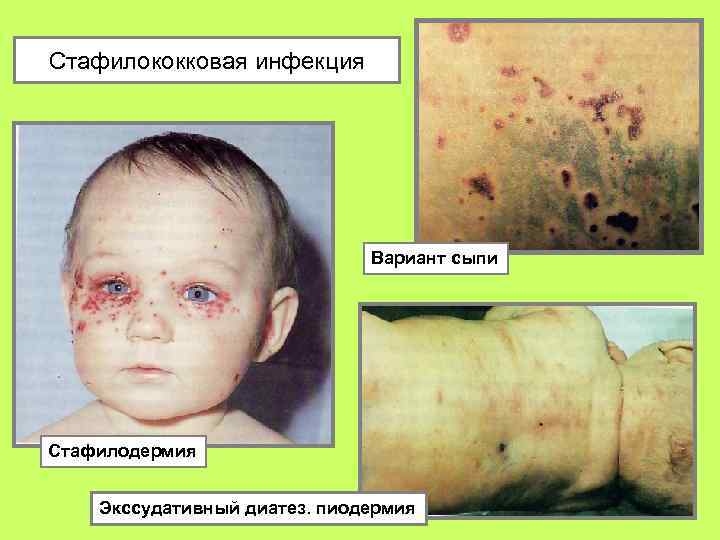 Стафилококковая инфекция Вариант сыпи Стафилодермия Экссудативный диатез. пиодермия 