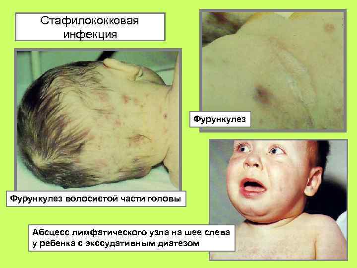 Стафилококковая инфекция Фурункулез волосистой части головы Абсцесс лимфатического узла на шее слева у ребенка