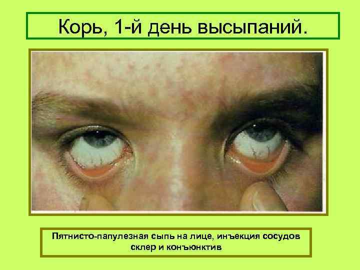 Корь, 1 -й день высыпаний. Пятнисто-папулезная сыпь на лице, инъекция сосудов склер и конъюнктив