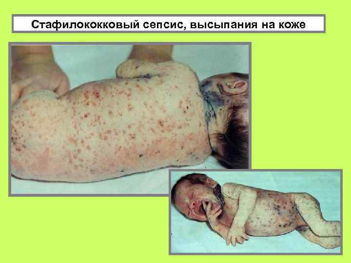 Стафилококковый сепсис, высыпания на коже 